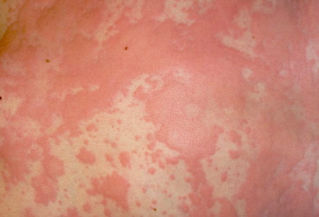 phototake-rm-hives_urticaria_skin_rash