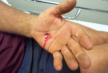 Nail-gun-injury-Hand-004-1