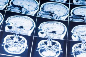 මොළය බේරා ගැනීම සඳහා විශේෂඥ මණ්ඩලයකින්&nbsp;යෝජනා