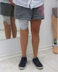 කෘතිම පාදය තමන්ගේම පාදය ලෙස දැනෙන්නට මගපාදන&nbsp;තාක්ෂණයක්