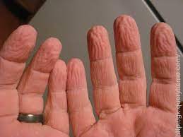 නෑමෙන් පසු ඇඟිලි  රැළි වැටී වර්ණය වෙනස් වන්නේ&nbsp;ඇයි?